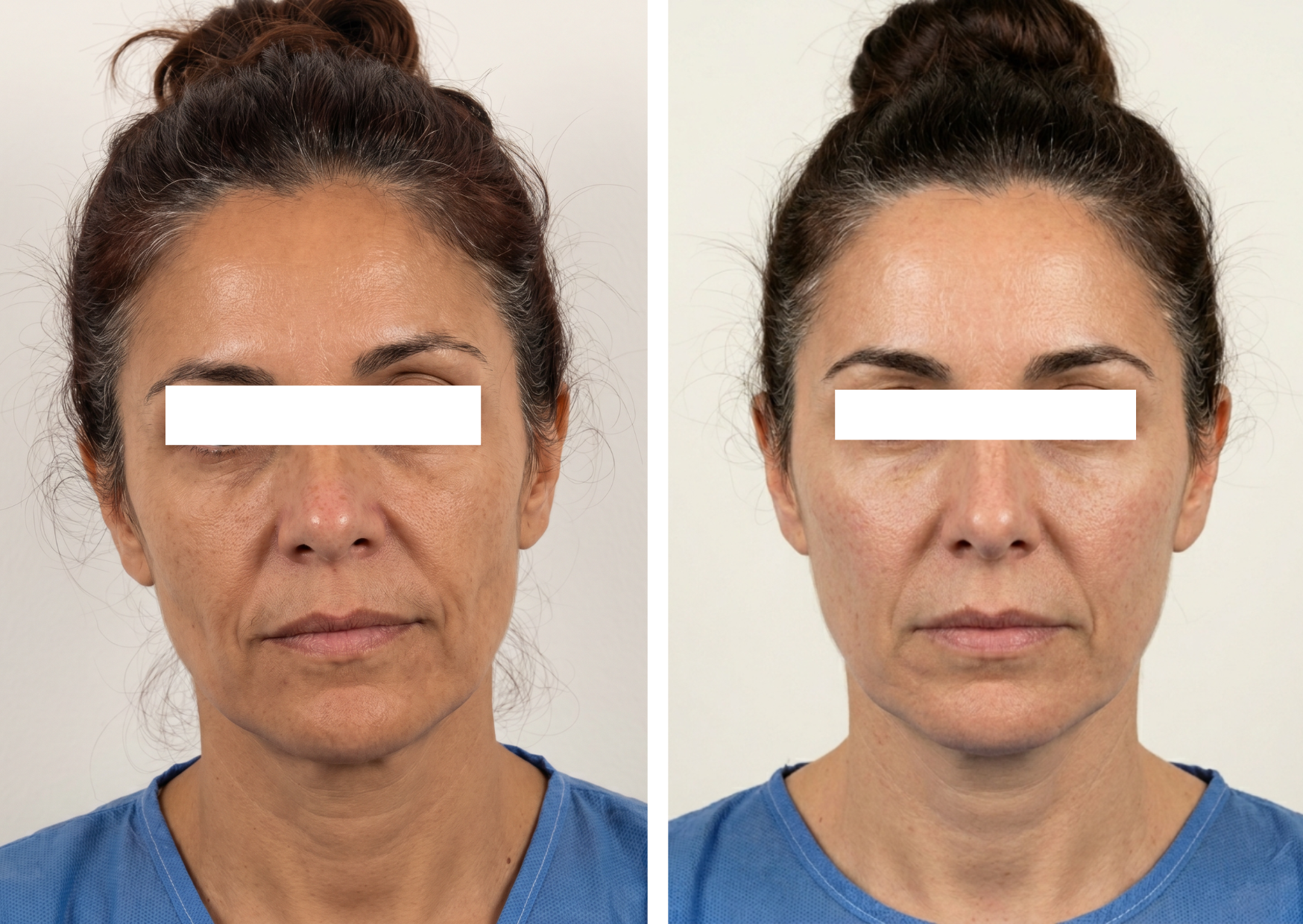 Rejuvenecimiento Facial Comprehensivo